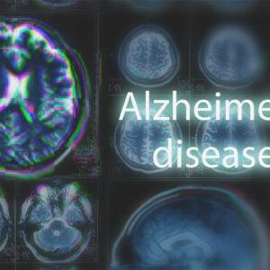 10 Early Signs of Alzheimer’s Disease