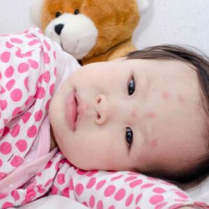 Here’s How to Identify Common Insect Bites