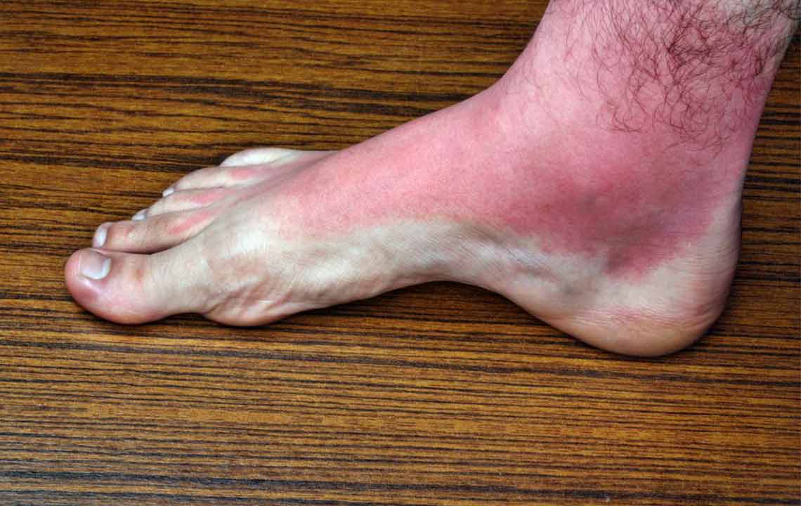 Heat rash: Causes, symptoms, and treatment