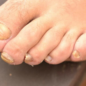 Toenail Fungus – Causes, Symptoms and Treatment